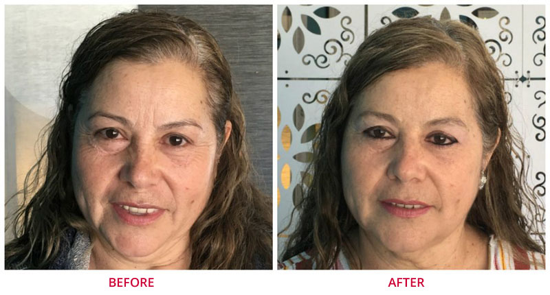 microneedling before after