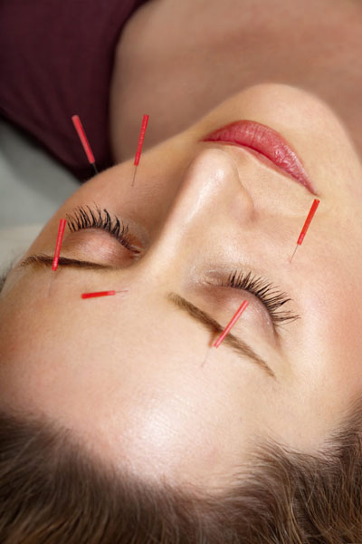 acupuncture facial