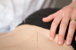 Person with acupuncture needles in their back