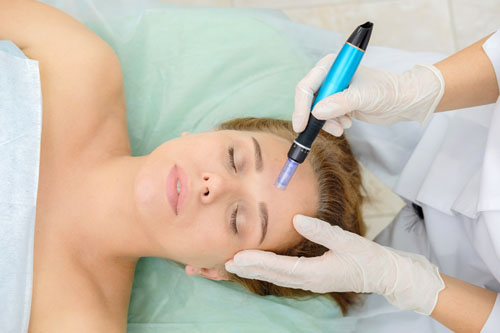 microneedling